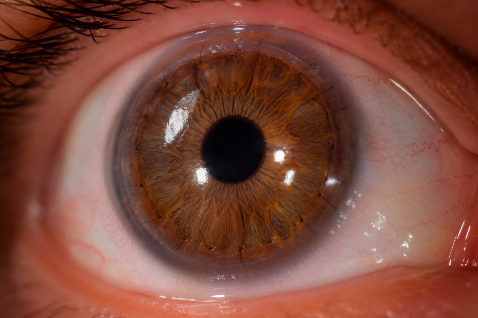 Trasplante Corneal QPP DSAEK DALK