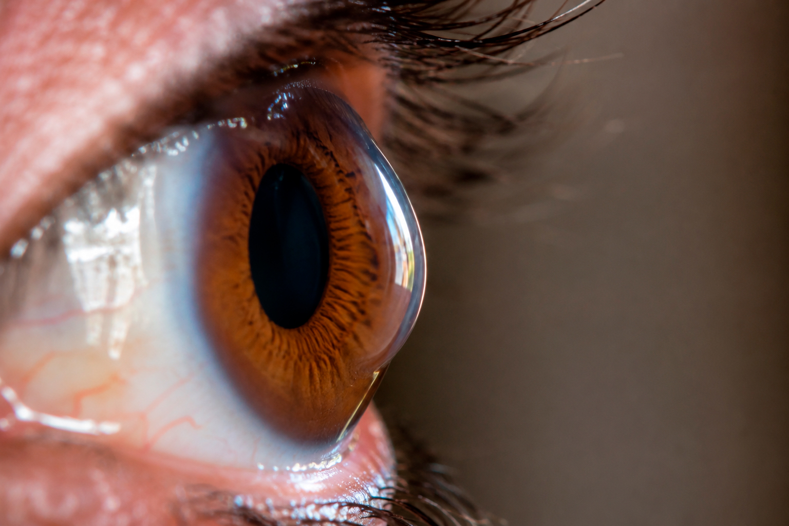 Queratocono y Crosslinking Corneal